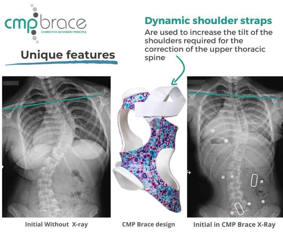 CMP Brace for Scoliosis 12 Before and after X-ray showing scoliosis curve correction with the CMP Brace