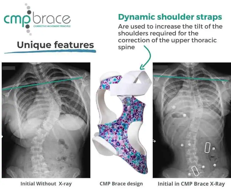 X-ray images showing scoliosis before and after CMP brace treatment with a colorful brace design for spinal correction.
